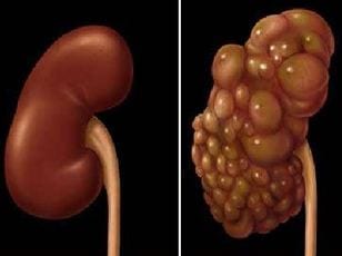 Kidney Failure