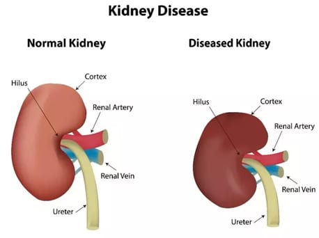 Kidney Disease failure