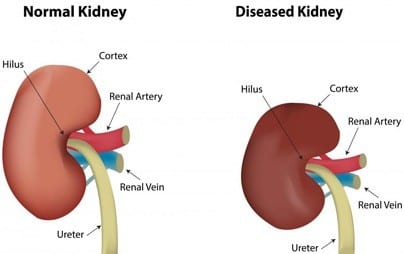 Kidney Disease