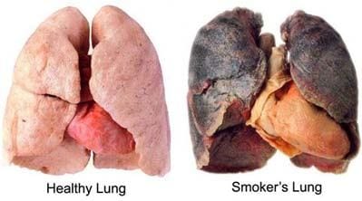 Healthy Lung vs Smokers Lung
