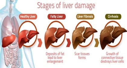 Stages of Liver damage
