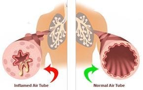 Clogged Arteries COPD