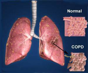 COPD