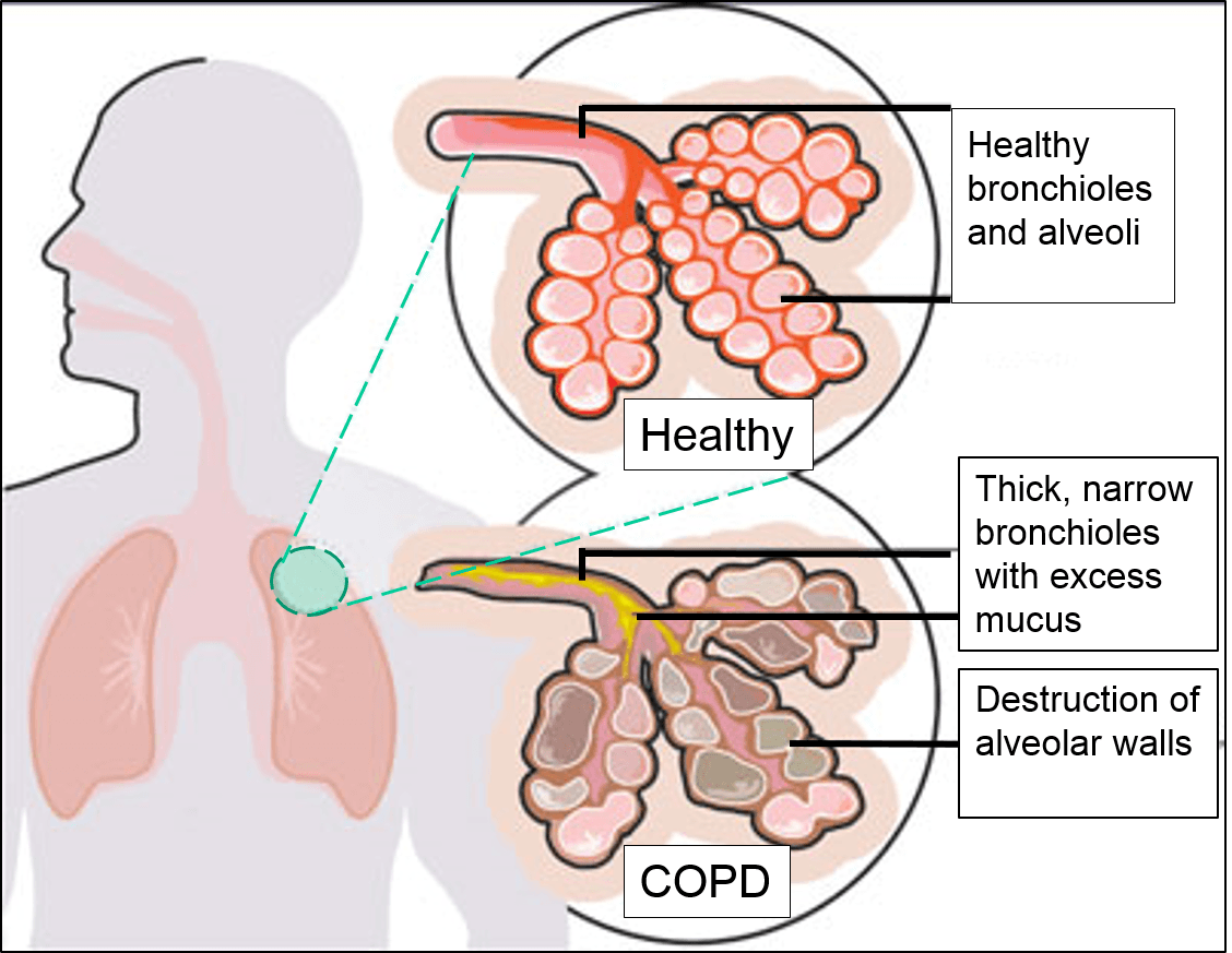 Alveoli COPD