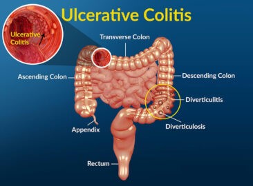 Symptoms Colitis, Ulcerative Colitis - Choose Your Life Style