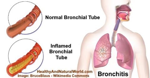 Bronchitis