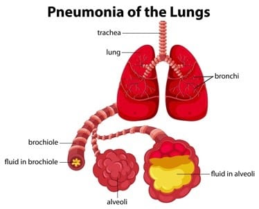 Pneumonia of the Lungs