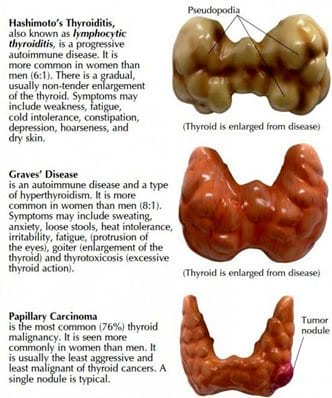 Thyroid Diseases