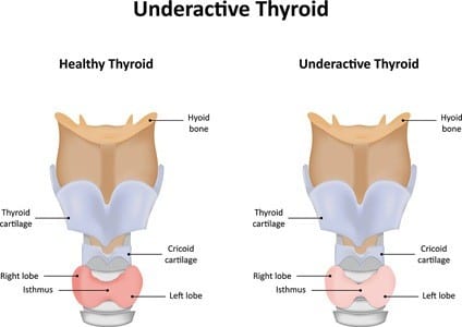 Under active Thyroid