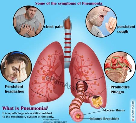 Pneumonia Symptoms Cures - Choose Your Life Style