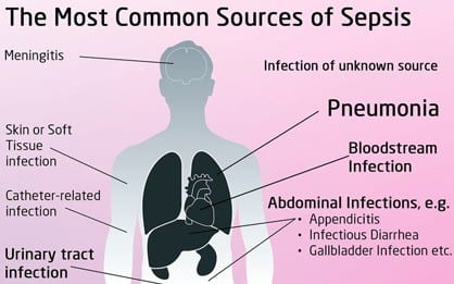 Causes of sepsis