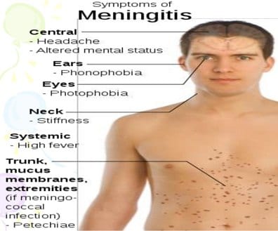 Symptoms of meningitis