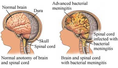 What causes Meningitis