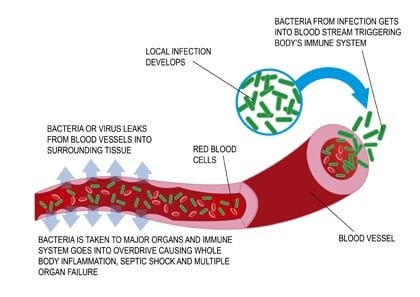 What is Sepsis