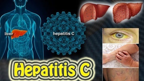 Hepatitis C Signs