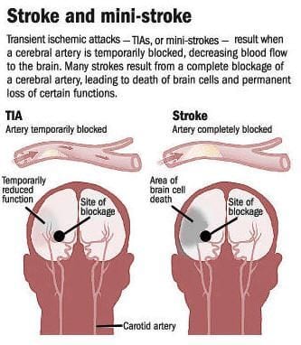 Stroke and Mini-Stroke