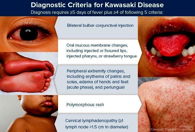 Diagnosis Kawasaki disease