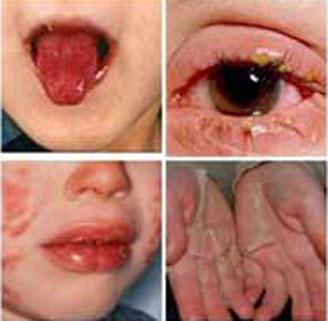 Kawasaki disease images