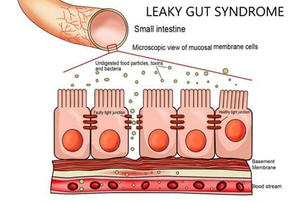 Leaky Gut Signs