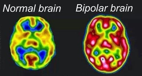 Bipolar disorder normal and bipolar depressed brain images