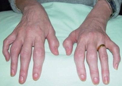 Psoriatic arthritis hands