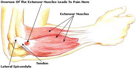 Tennis elbow pain