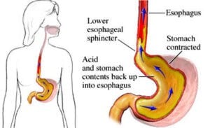 Acid Reflux Signs Symptoms - Choose Your Life Style