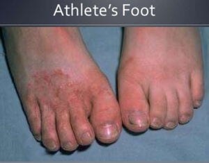 Athlete's Foot symptoms