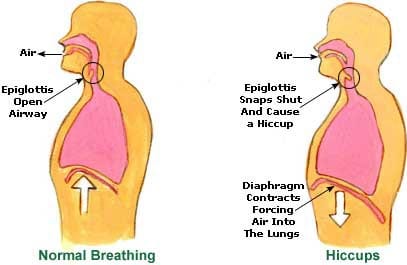 Causes of Hiccups