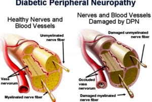 What Diabetic Neuropathy looks like in the feet