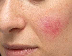 What Rosacea looks like