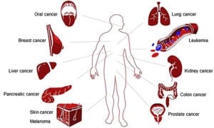 Most common Cancer list