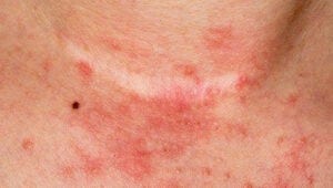 Types of Skin Eczema. Atopic Eczema