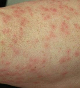 Types of Skin Eczema. Contact Demetris