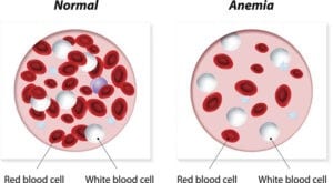 Anemia, normal and anemic blood cells