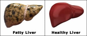 image-fatty -liver-healthy-liver